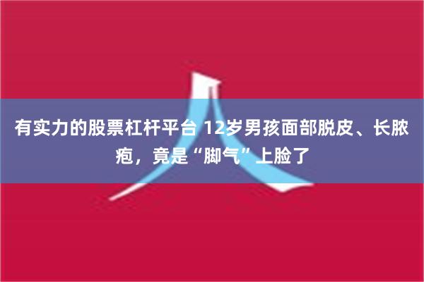 有实力的股票杠杆平台 12岁男孩面部脱皮、长脓疱，竟是“脚气”上脸了